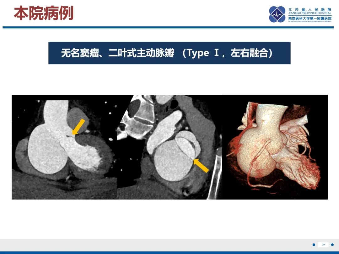 影像PPT - 【PPT】主动脉窦瘤-30