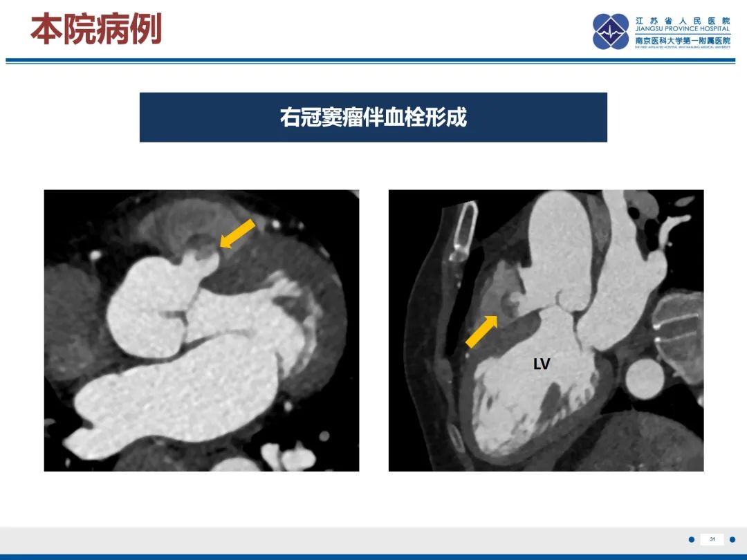 影像PPT - 【PPT】主动脉窦瘤-32
