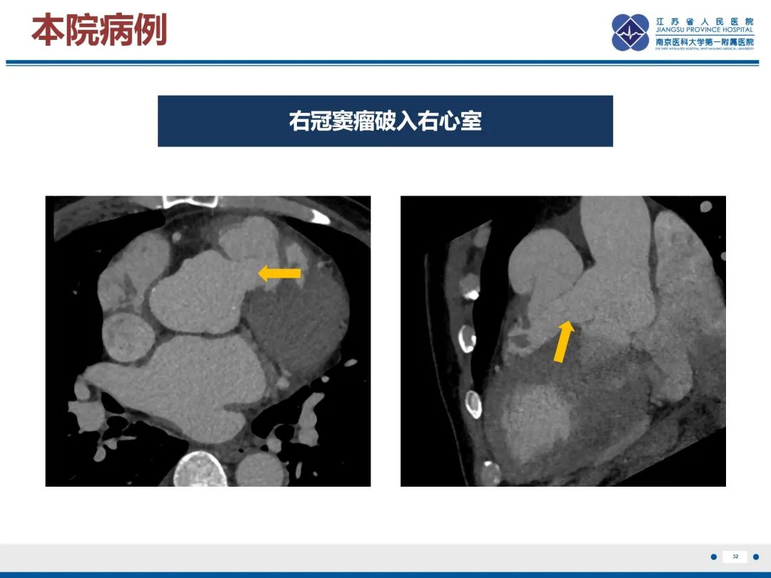 影像PPT - 【PPT】主动脉窦瘤-33