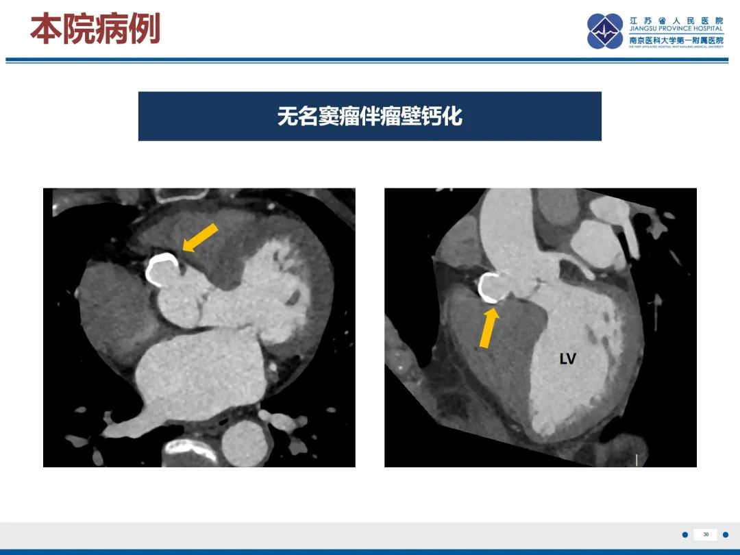 影像PPT - 【PPT】主动脉窦瘤-31