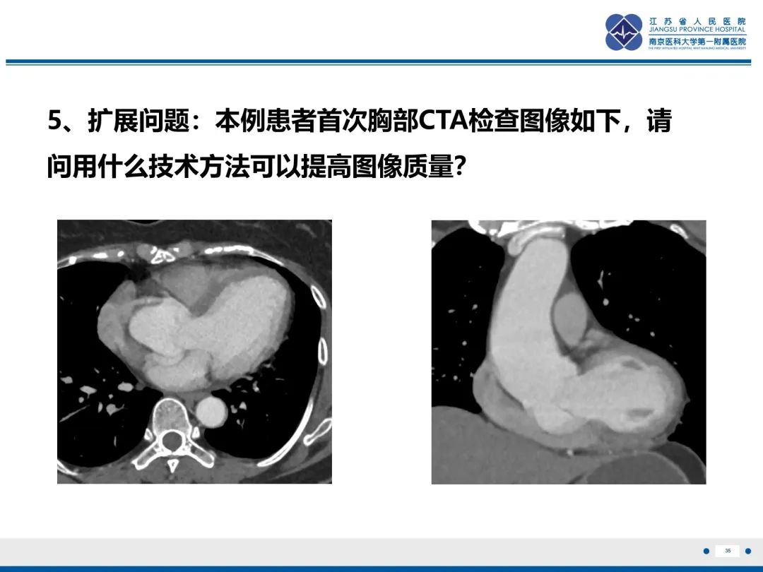 影像PPT - 【PPT】主动脉窦瘤-36