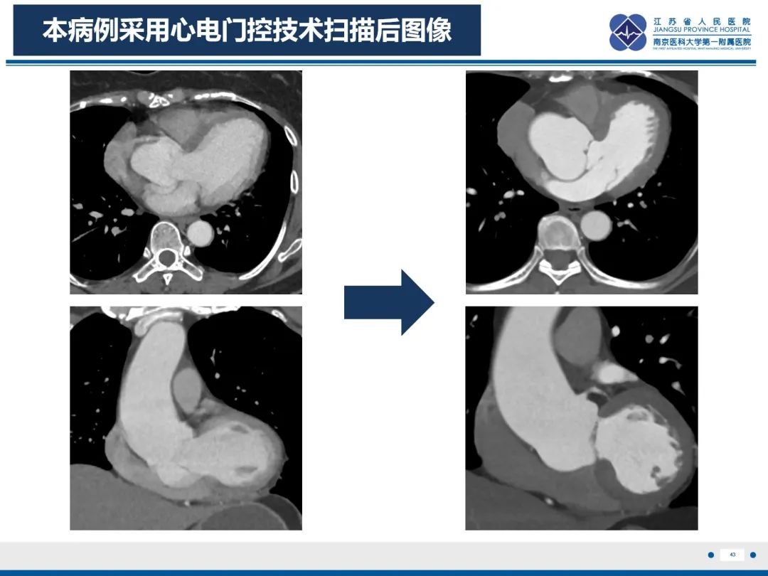 影像PPT - 【PPT】主动脉窦瘤-44