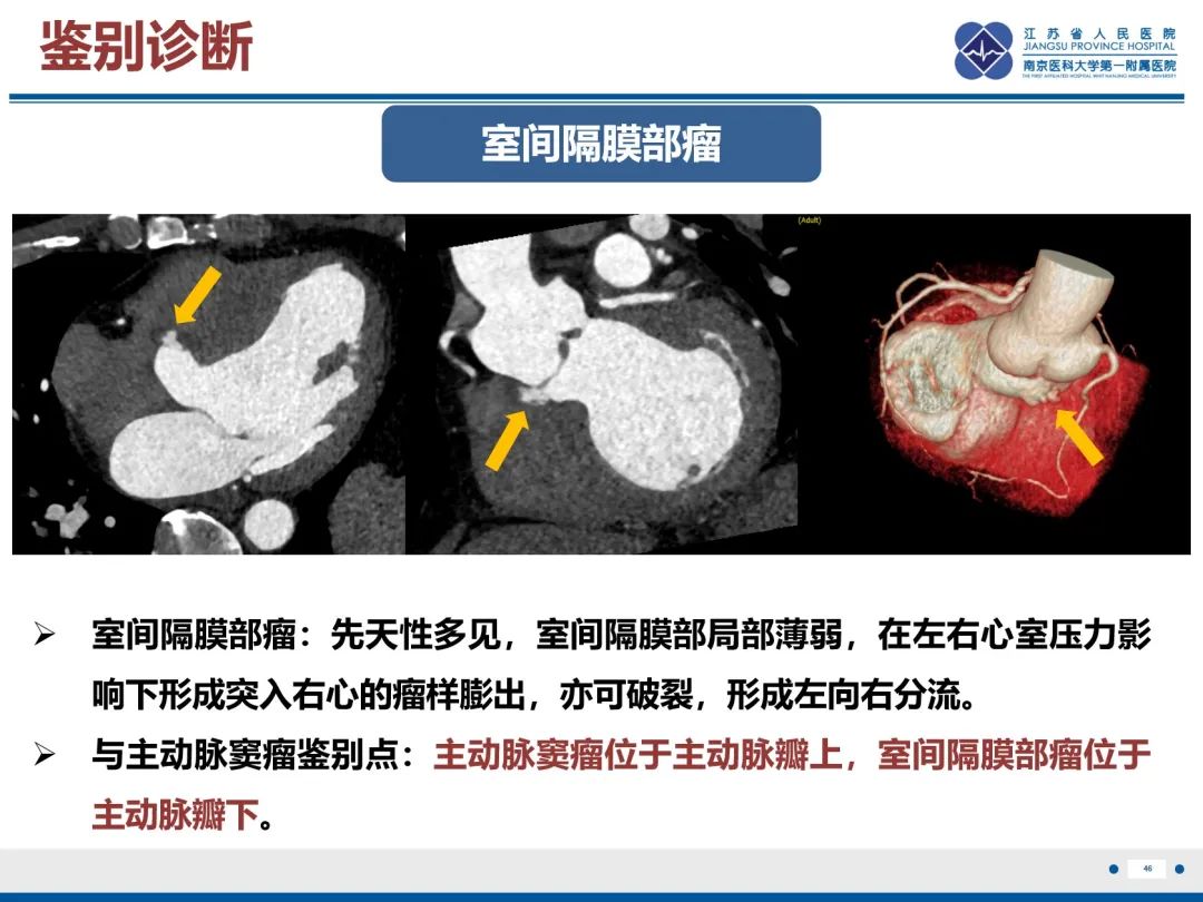 影像PPT - 【PPT】主动脉窦瘤-47