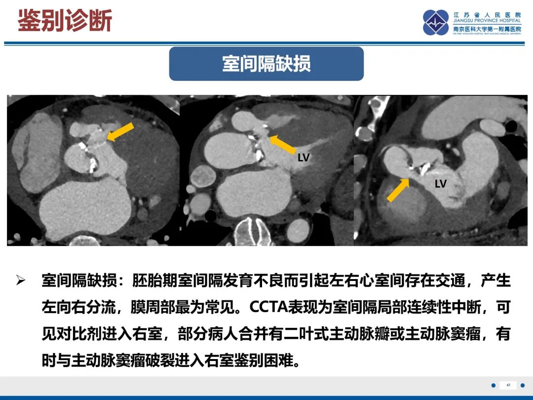 影像PPT - 【PPT】主动脉窦瘤-48