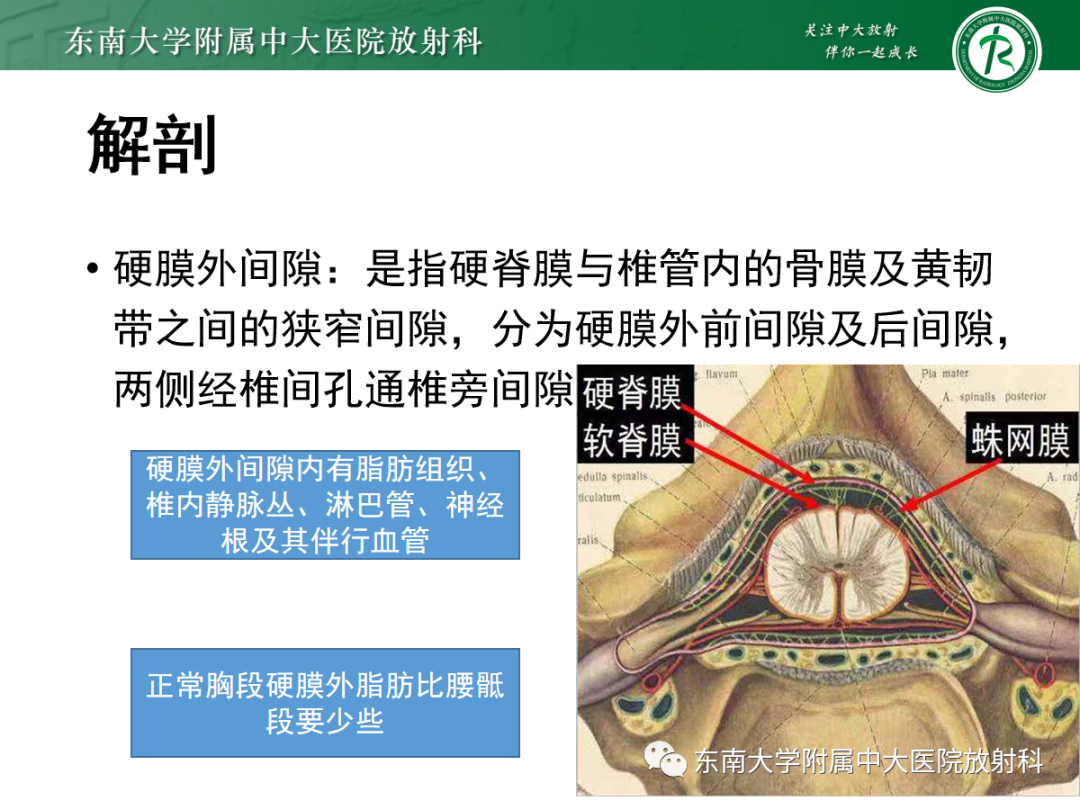 影像PPT - 【PPT】椎管内硬膜外脂肪增多症-3