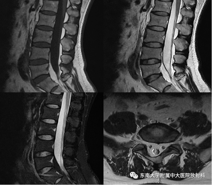 影像PPT - 【PPT】椎管内硬膜外脂肪增多症-1