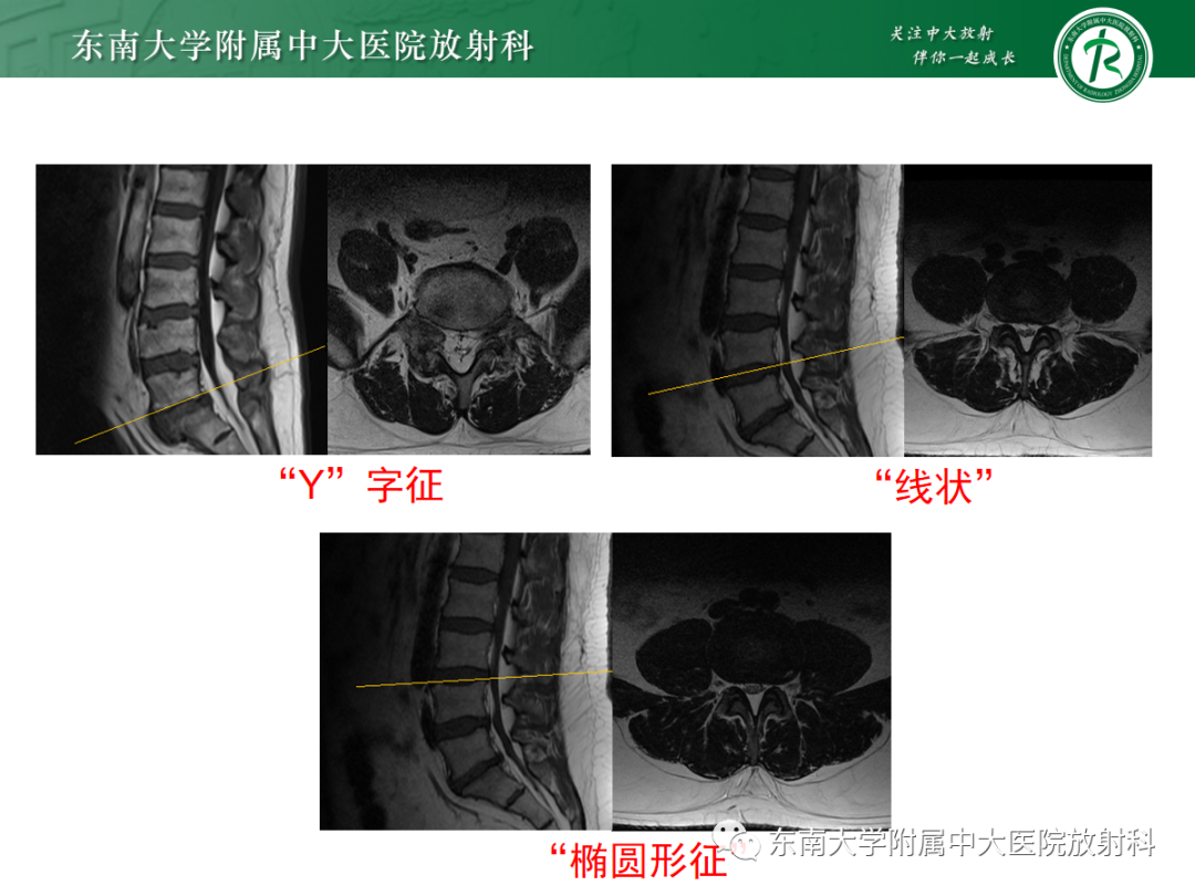影像PPT - 【PPT】椎管内硬膜外脂肪增多症-10