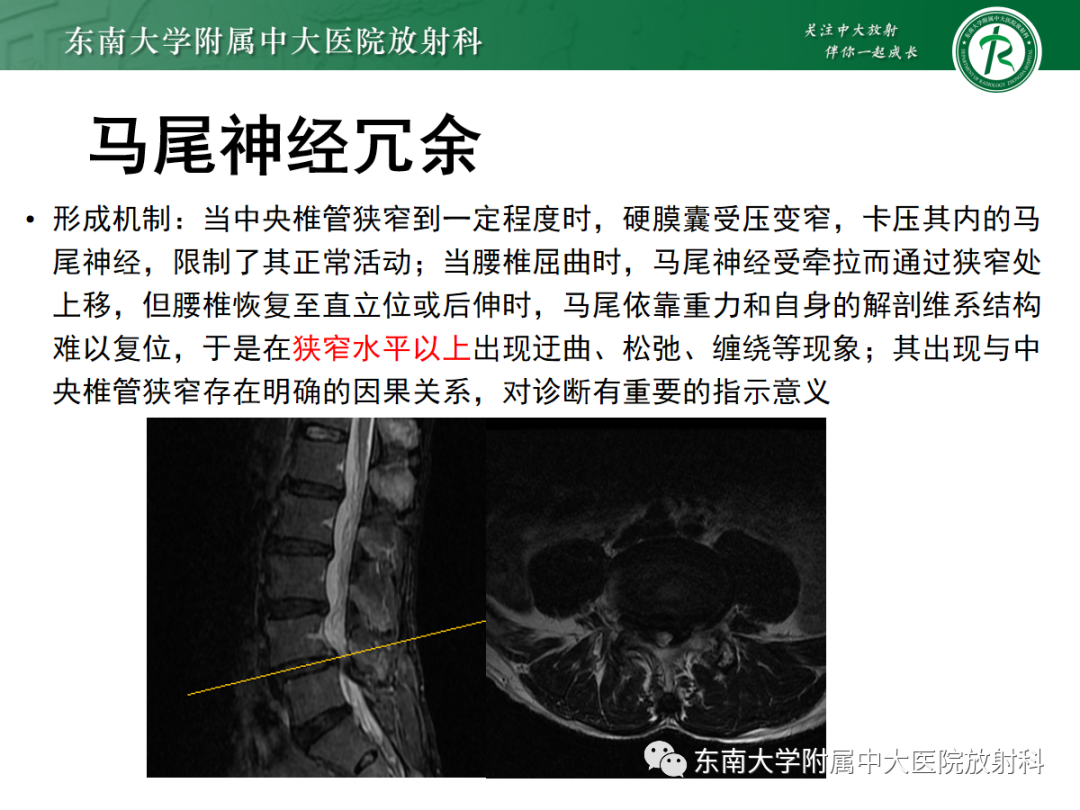 影像PPT - 【PPT】椎管内硬膜外脂肪增多症-12