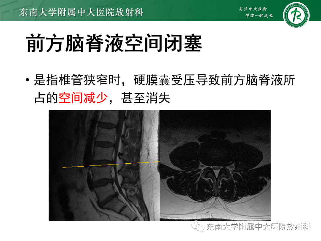 影像PPT - 【PPT】椎管内硬膜外脂肪增多症-14