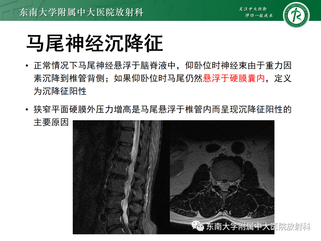 影像PPT - 【PPT】椎管内硬膜外脂肪增多症-13