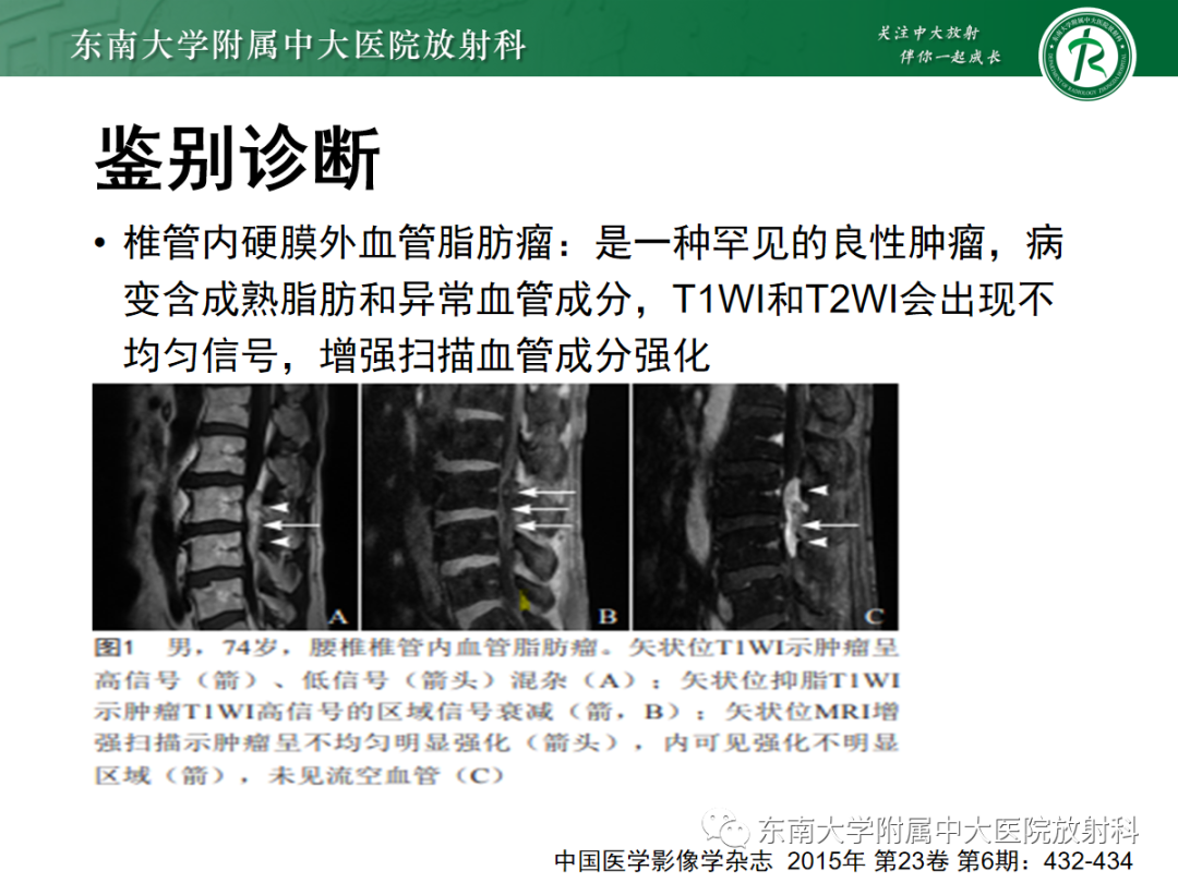 影像PPT - 【PPT】椎管内硬膜外脂肪增多症-15