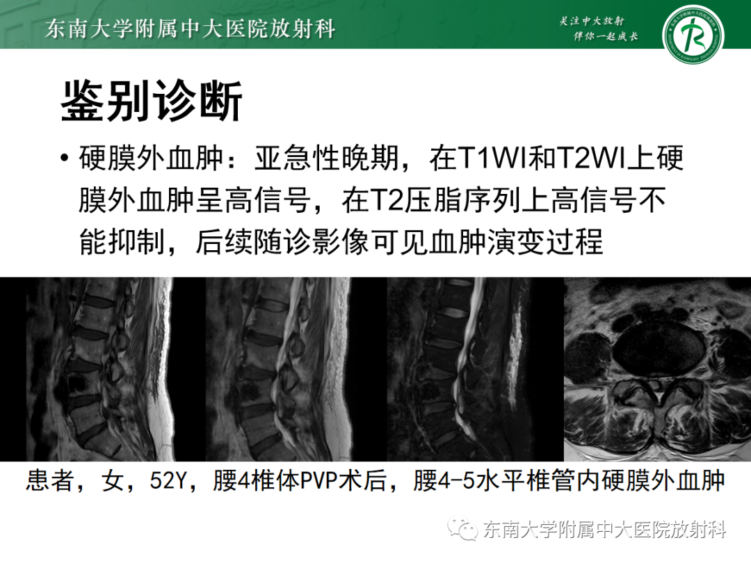 影像PPT - 【PPT】椎管内硬膜外脂肪增多症-16