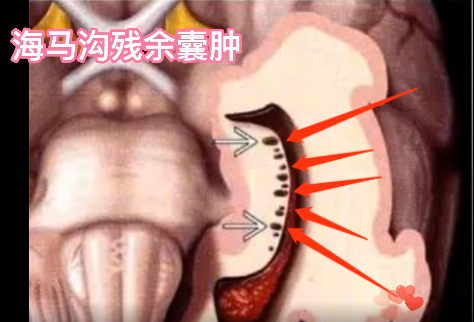 影像PPT - 【病例】海马沟残余囊肿1例MR影像-4 影像PPT - 【病例】海马沟残余囊肿1例MR影像-4