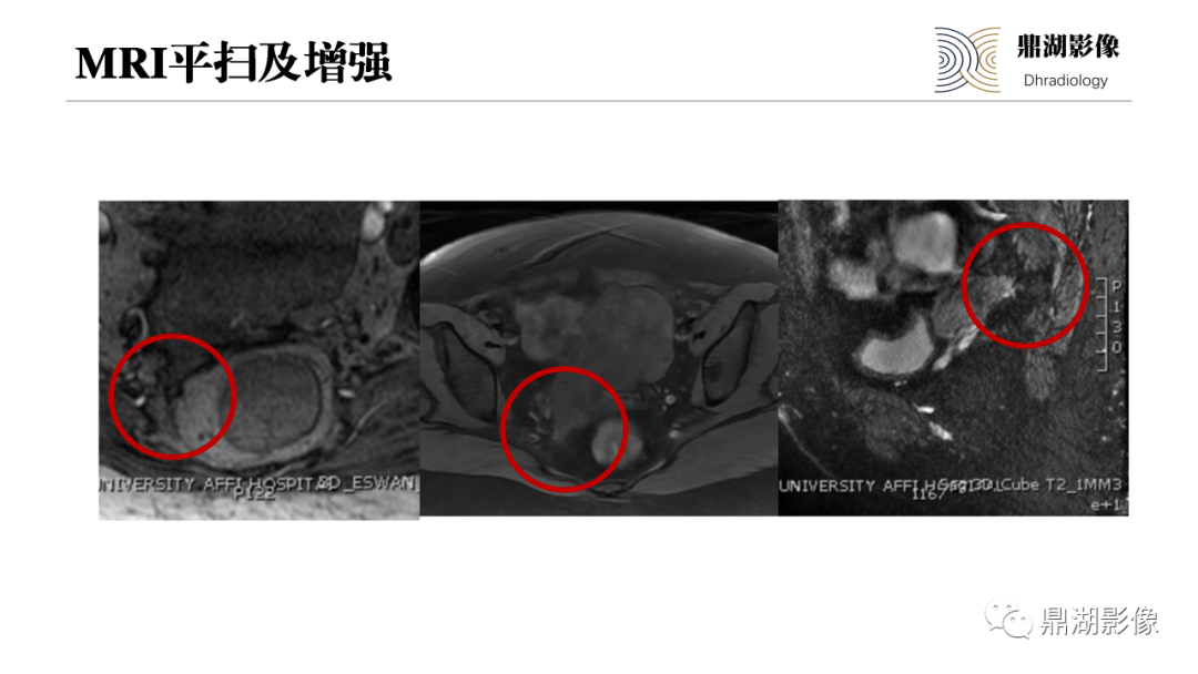 影像PPT - 【PPT】深部浸润型子宫内膜异位症诊断及鉴别-7