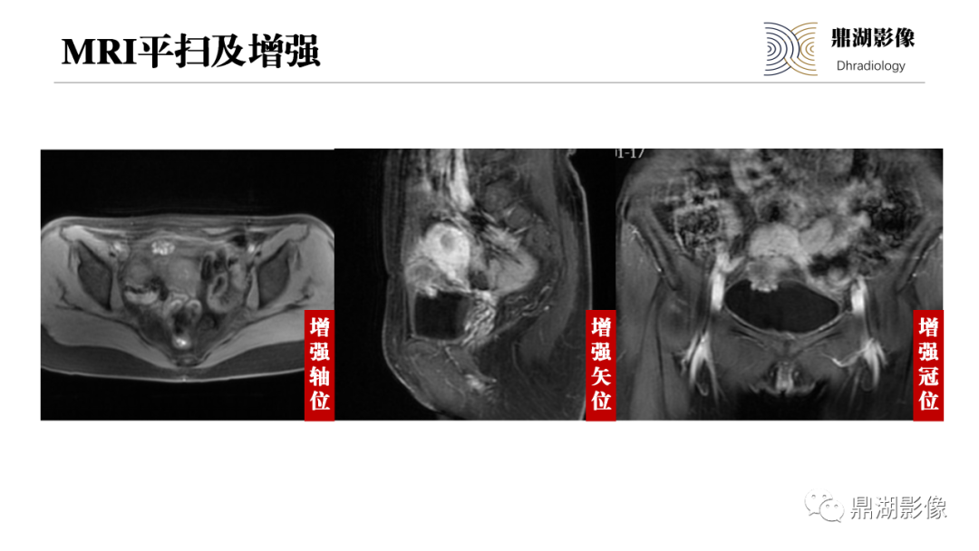 影像PPT - 【PPT】深部浸润型子宫内膜异位症诊断及鉴别-12