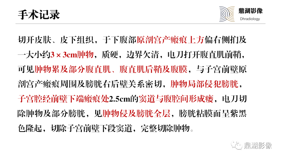 影像PPT - 【PPT】深部浸润型子宫内膜异位症诊断及鉴别-14