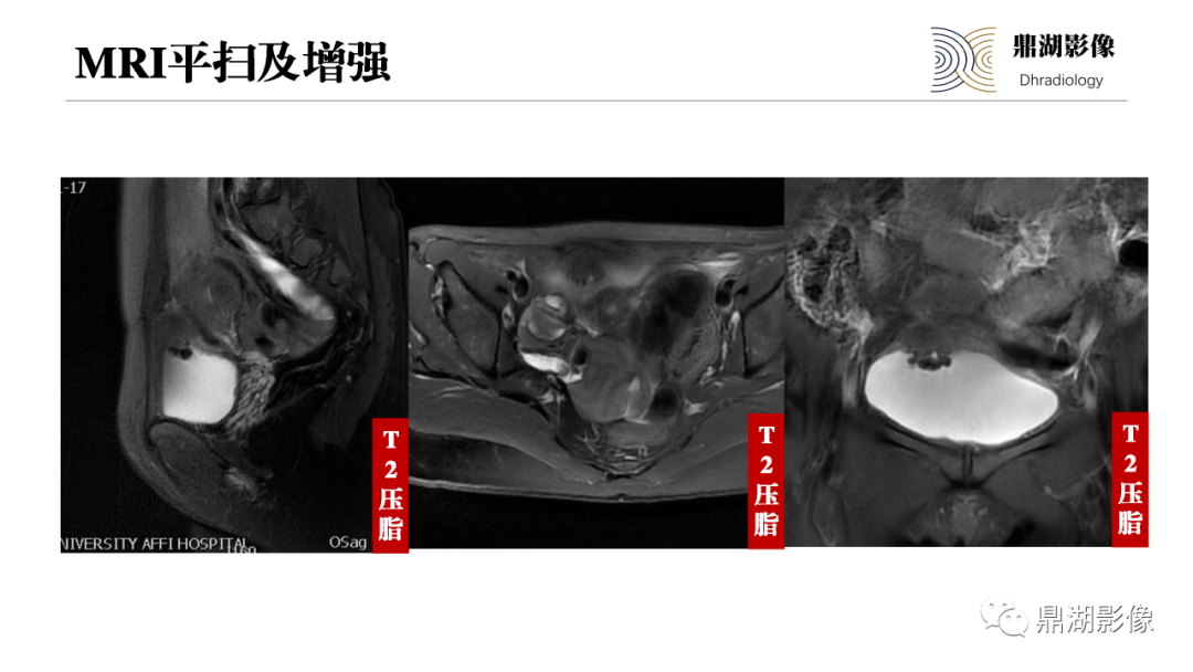 影像PPT - 【PPT】深部浸润型子宫内膜异位症诊断及鉴别-11