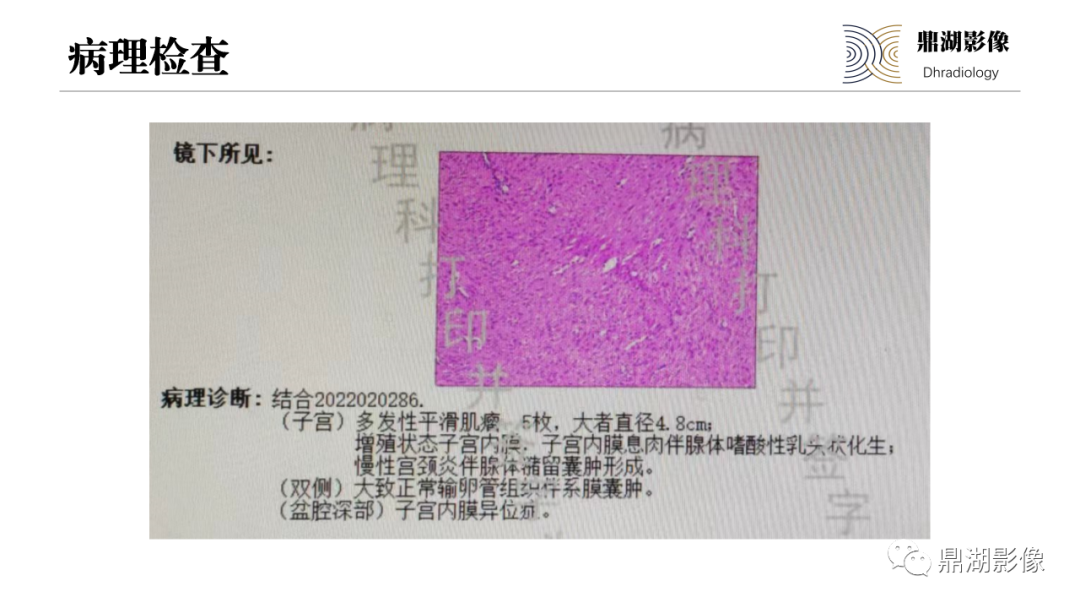 影像PPT - 【PPT】深部浸润型子宫内膜异位症诊断及鉴别-9