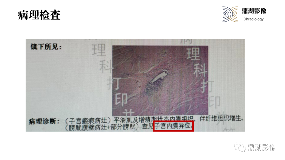 影像PPT - 【PPT】深部浸润型子宫内膜异位症诊断及鉴别-15