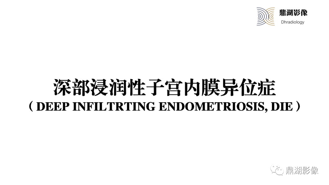 影像PPT - 【PPT】深部浸润型子宫内膜异位症诊断及鉴别-17