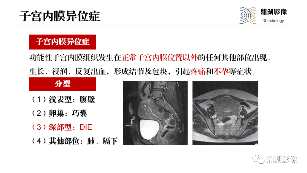 影像PPT - 【PPT】深部浸润型子宫内膜异位症诊断及鉴别-18