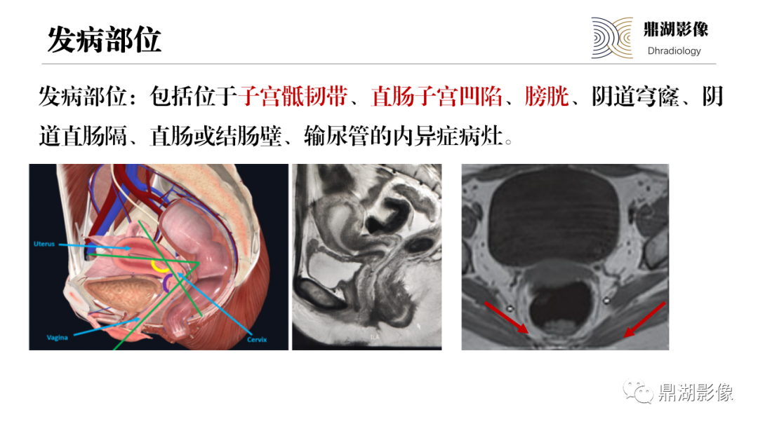 影像PPT - 【PPT】深部浸润型子宫内膜异位症诊断及鉴别-21