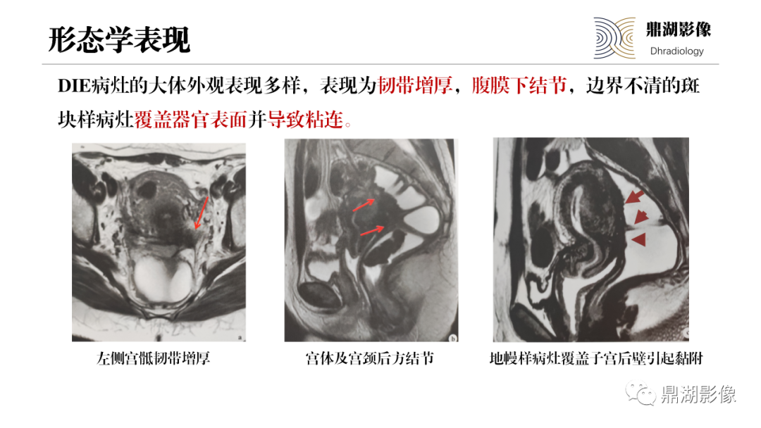 影像PPT - 【PPT】深部浸润型子宫内膜异位症诊断及鉴别-25