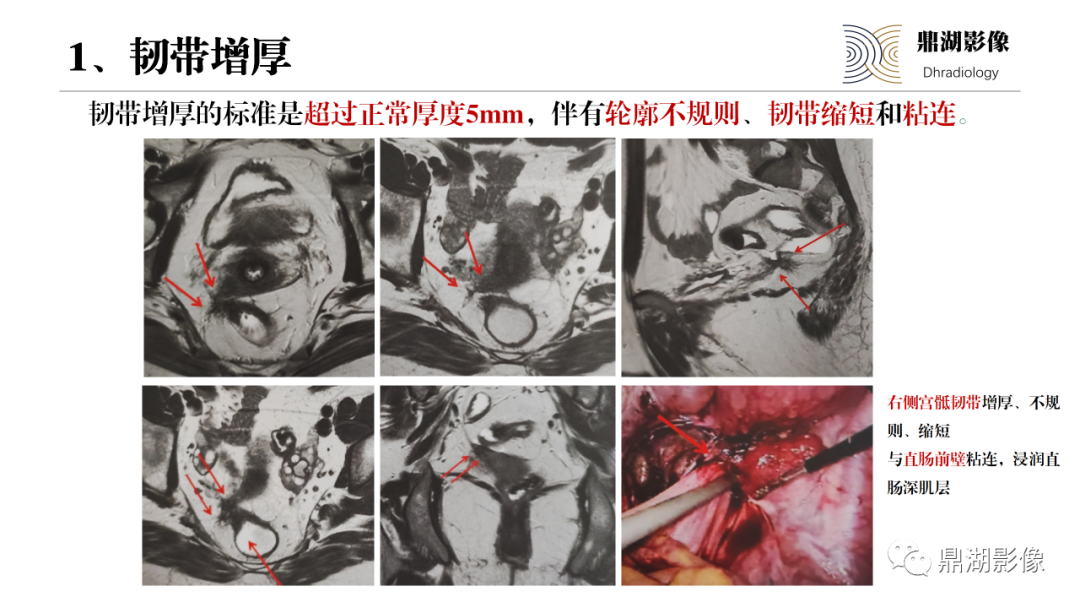 影像PPT - 【PPT】深部浸润型子宫内膜异位症诊断及鉴别-26