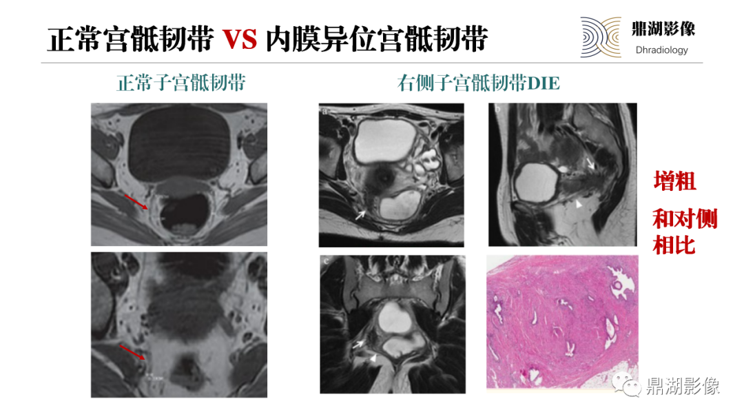 影像PPT - 【PPT】深部浸润型子宫内膜异位症诊断及鉴别-27