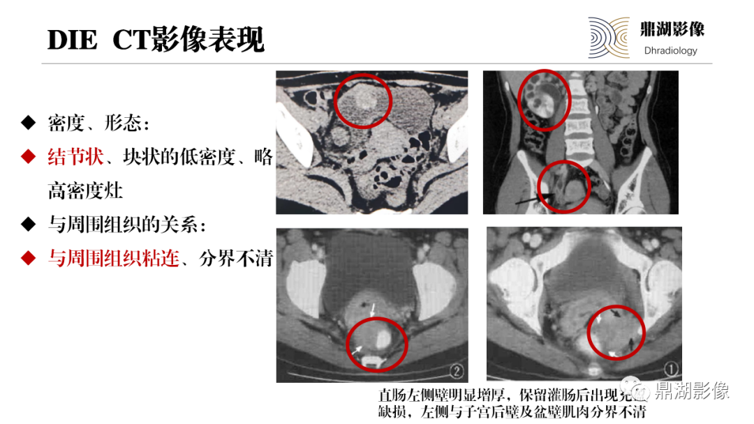 影像PPT - 【PPT】深部浸润型子宫内膜异位症诊断及鉴别-23