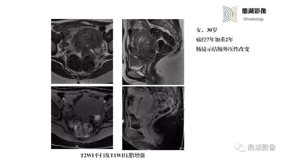 影像PPT - 【PPT】深部浸润型子宫内膜异位症诊断及鉴别-29