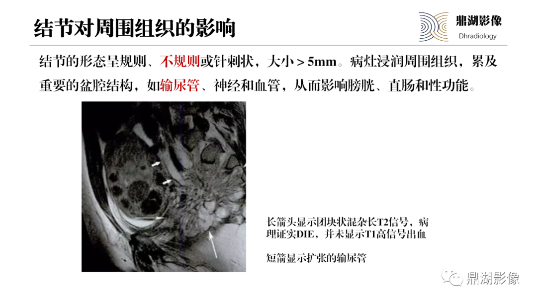 影像PPT - 【PPT】深部浸润型子宫内膜异位症诊断及鉴别-31