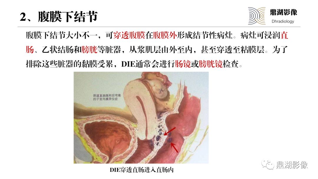 影像PPT - 【PPT】深部浸润型子宫内膜异位症诊断及鉴别-28