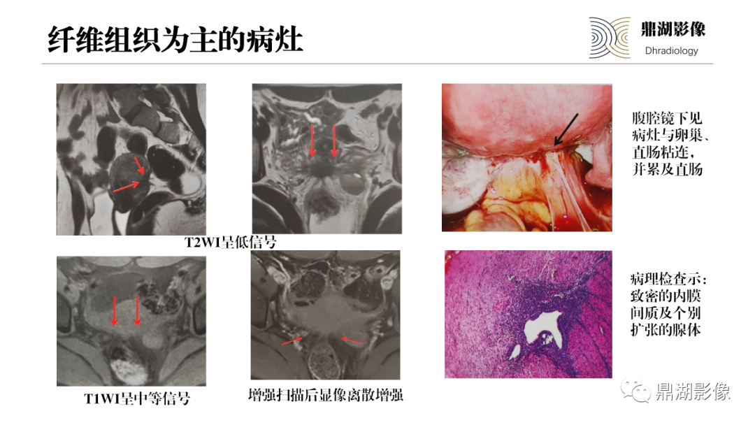 影像PPT - 【PPT】深部浸润型子宫内膜异位症诊断及鉴别-34