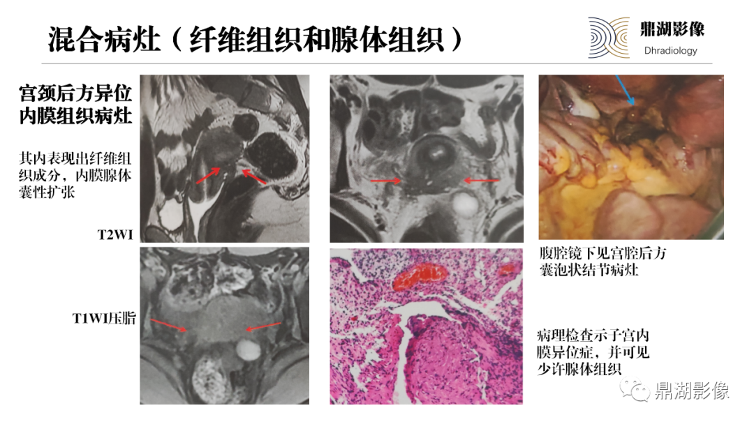 影像PPT - 【PPT】深部浸润型子宫内膜异位症诊断及鉴别-36