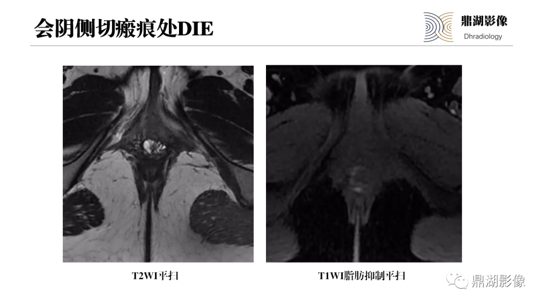影像PPT - 【PPT】深部浸润型子宫内膜异位症诊断及鉴别-40