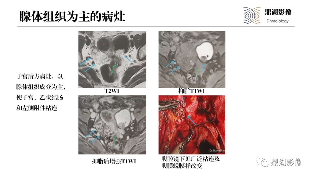 影像PPT - 【PPT】深部浸润型子宫内膜异位症诊断及鉴别-38