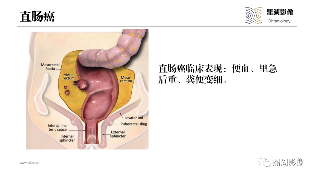影像PPT - 【PPT】深部浸润型子宫内膜异位症诊断及鉴别-51