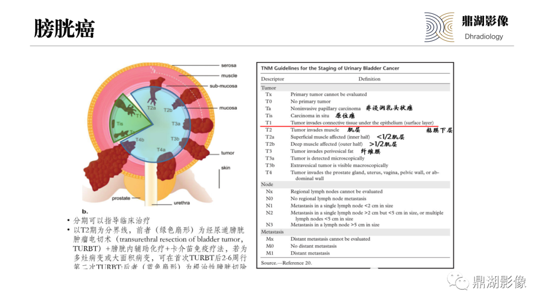 影像PPT - 【PPT】深部浸润型子宫内膜异位症诊断及鉴别-57
