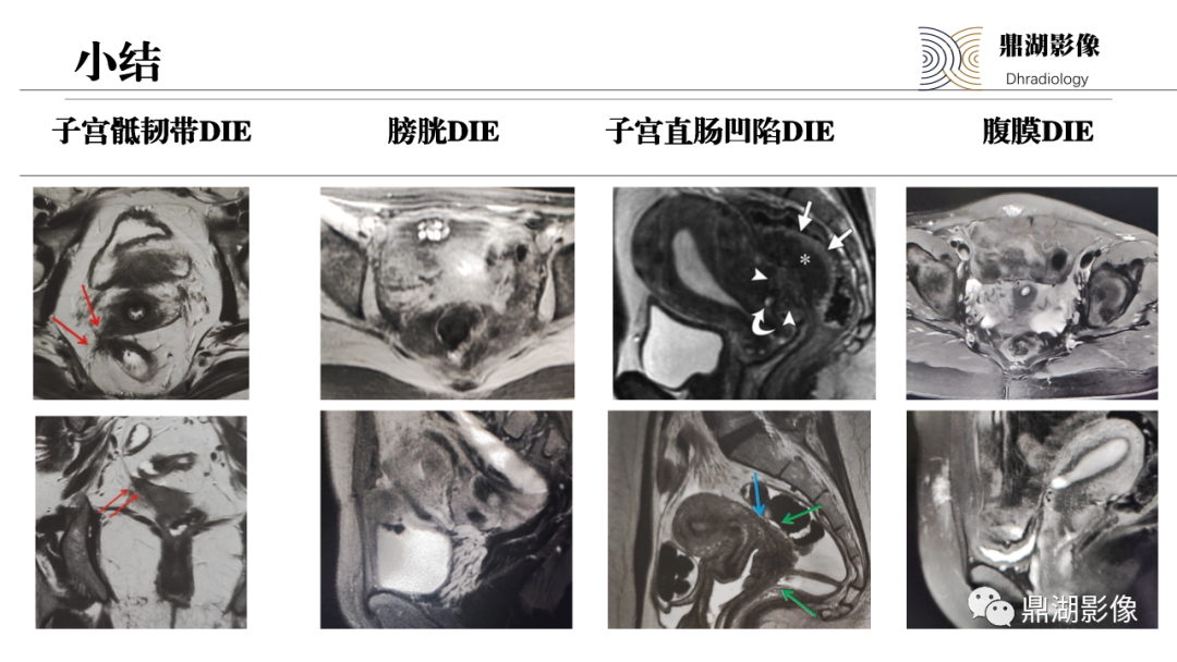 影像PPT - 【PPT】深部浸润型子宫内膜异位症诊断及鉴别-60