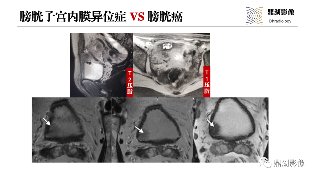 影像PPT - 【PPT】深部浸润型子宫内膜异位症诊断及鉴别-58