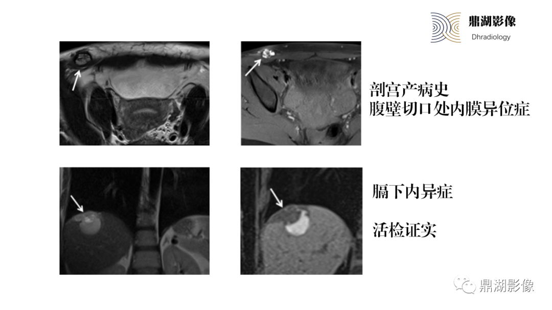 影像PPT - 【PPT】深部浸润型子宫内膜异位症诊断及鉴别-1
