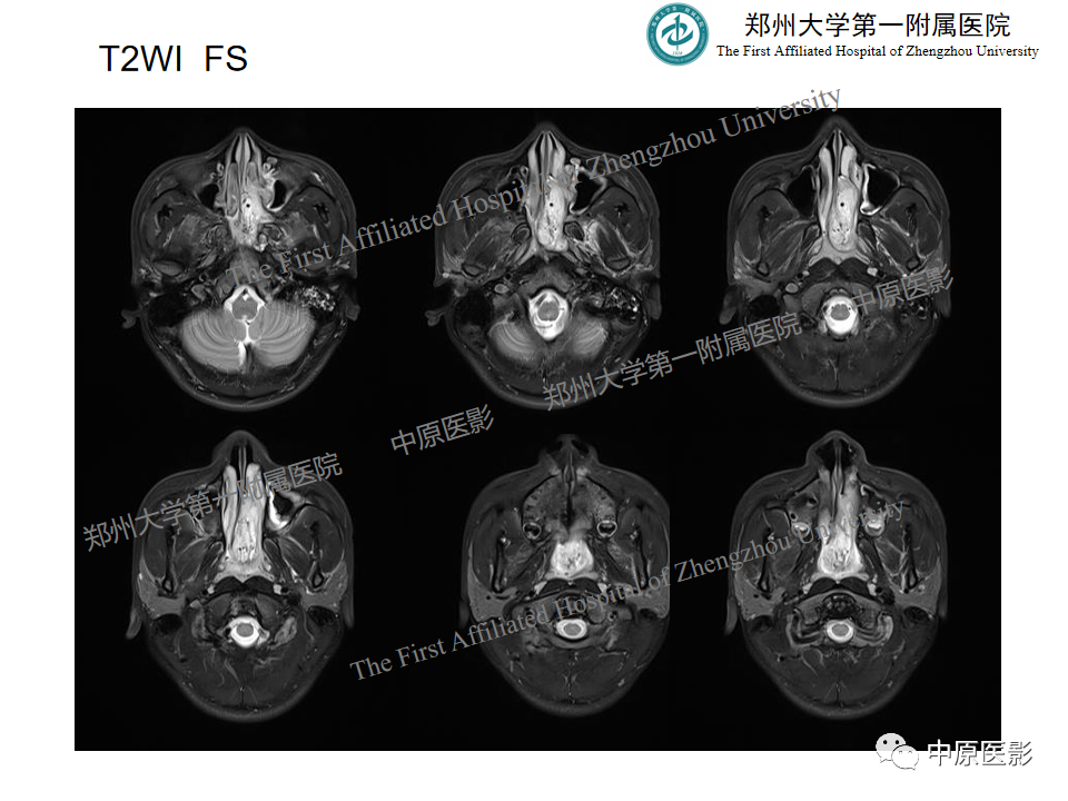 影像PPT - 【病例】鼻咽纤维血管瘤1例MR-5