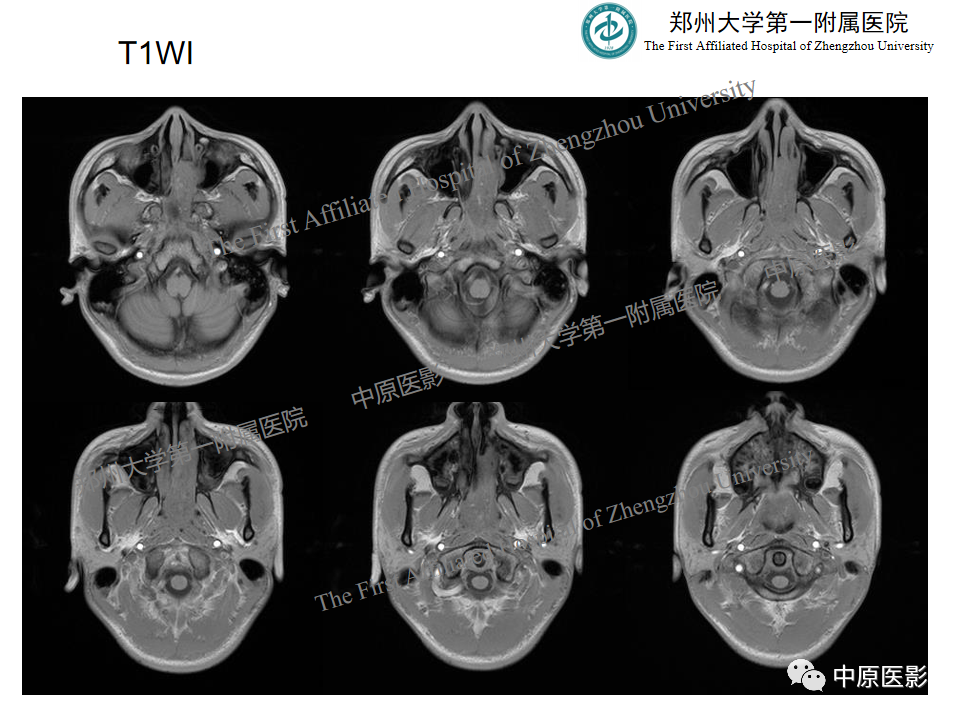 影像PPT - 【病例】鼻咽纤维血管瘤1例MR-3