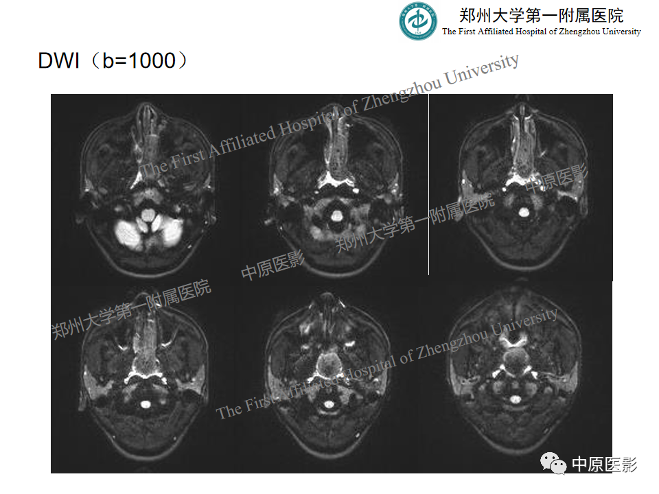 影像PPT - 【病例】鼻咽纤维血管瘤1例MR-7