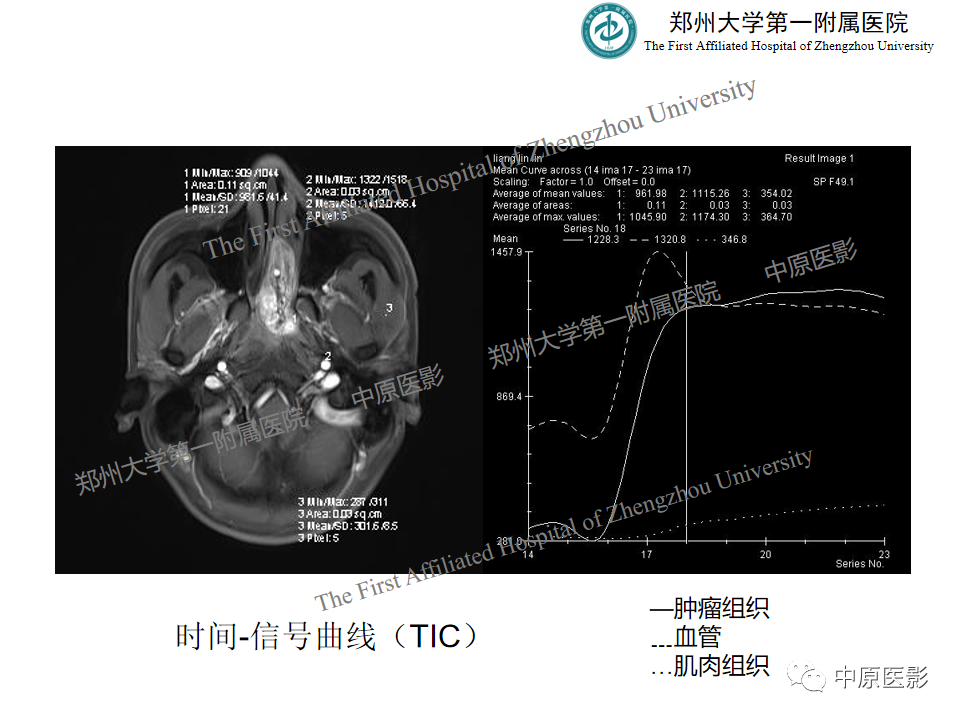 影像PPT - 【病例】鼻咽纤维血管瘤1例MR-12