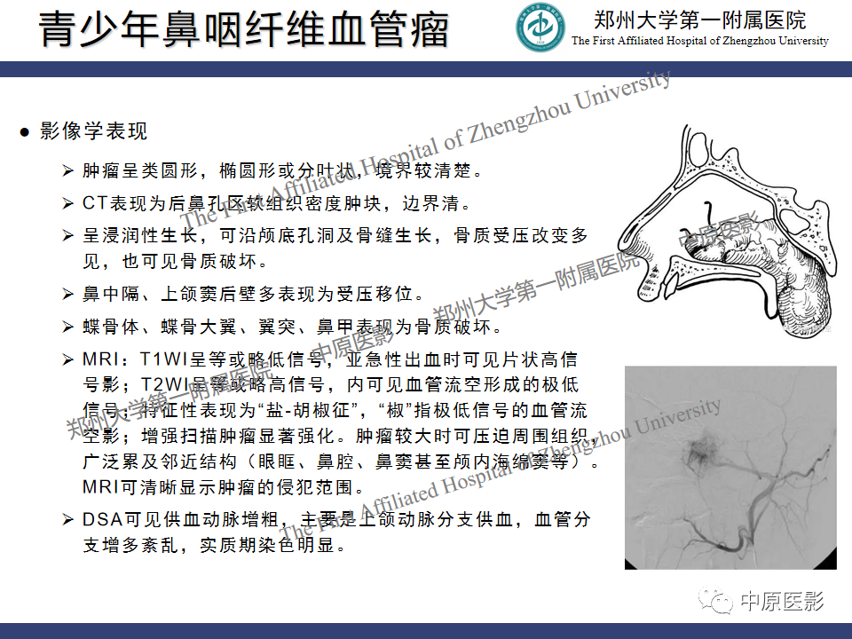 影像PPT - 【病例】鼻咽纤维血管瘤1例MR-19