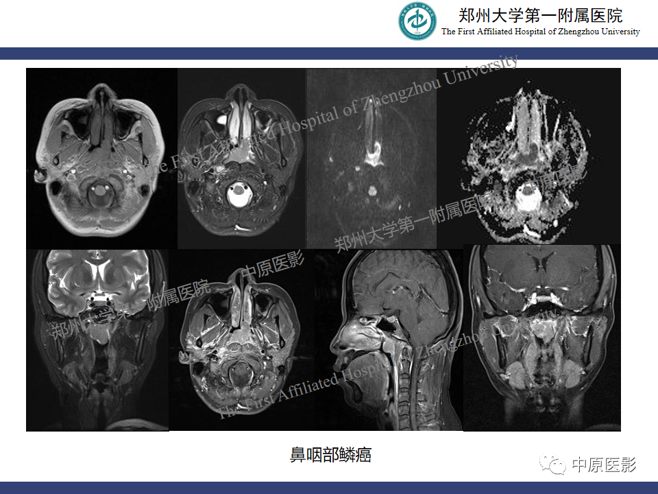 影像PPT - 【病例】鼻咽纤维血管瘤1例MR-22