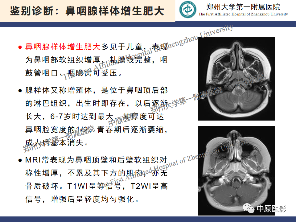 影像PPT - 【病例】鼻咽纤维血管瘤1例MR-23