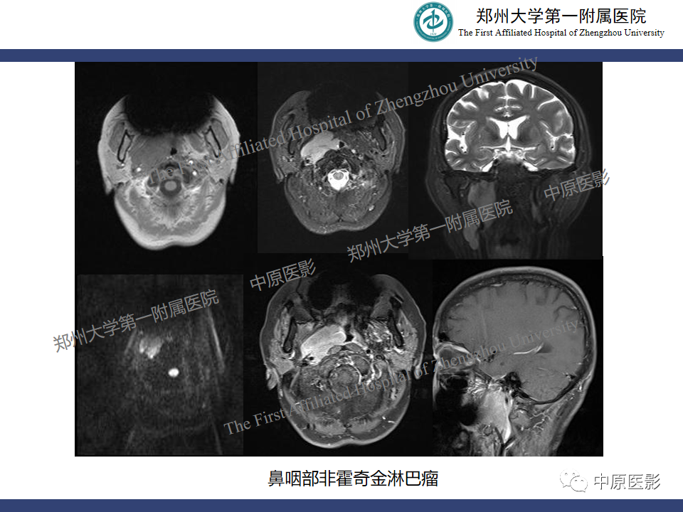 影像PPT - 【病例】鼻咽纤维血管瘤1例MR-25
